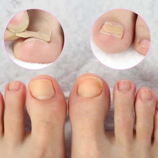 Kit De Tratamento De Correção De Unhas Encravada - Frete Grátis