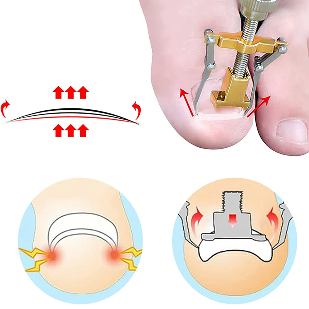 Kit De Tratamento De Correção De Unhas Encravada - Frete Grátis