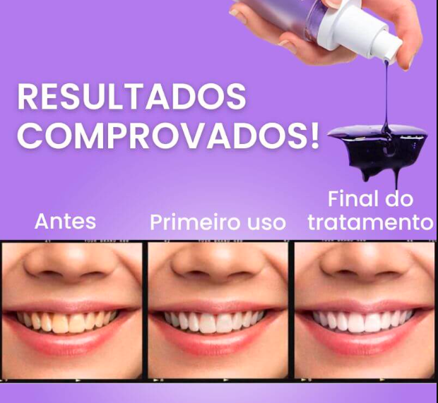 Clareador Dental Smile V34 - Dentes Brancos Em Segundos